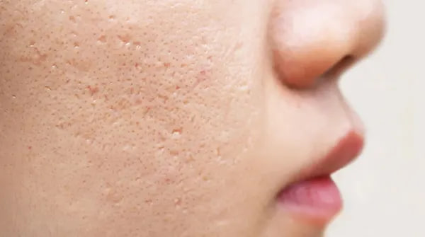 اگر میخواهید جوش نزنید این کار را انجام دهید