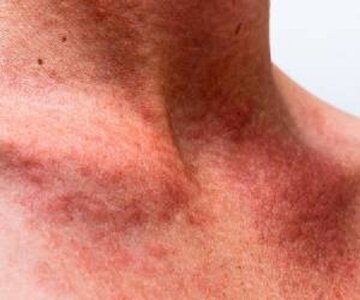 ۵ روش ساده برای تسکین فوری عرق‌ سوزی